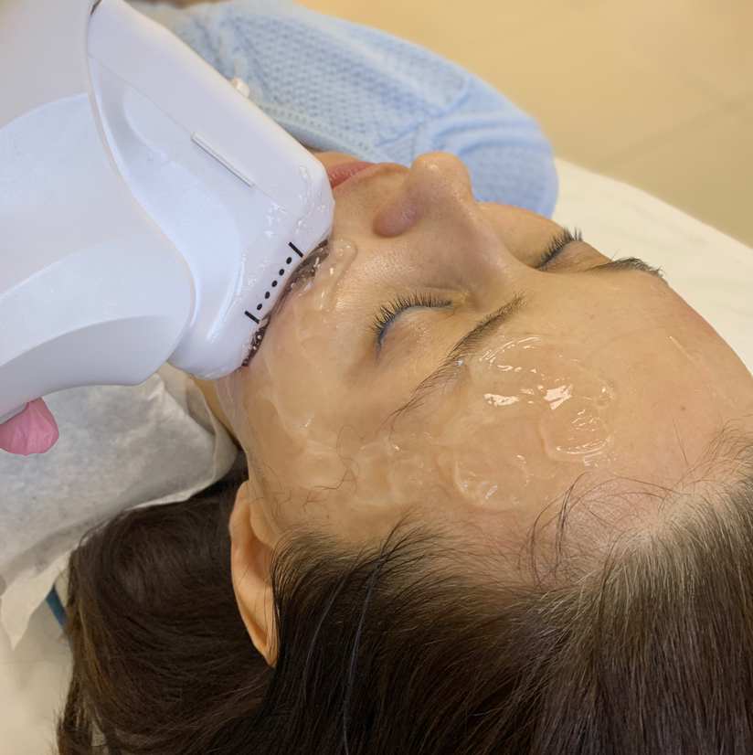 Smas лифтинг (Средняя треть: щёки, носогубки)