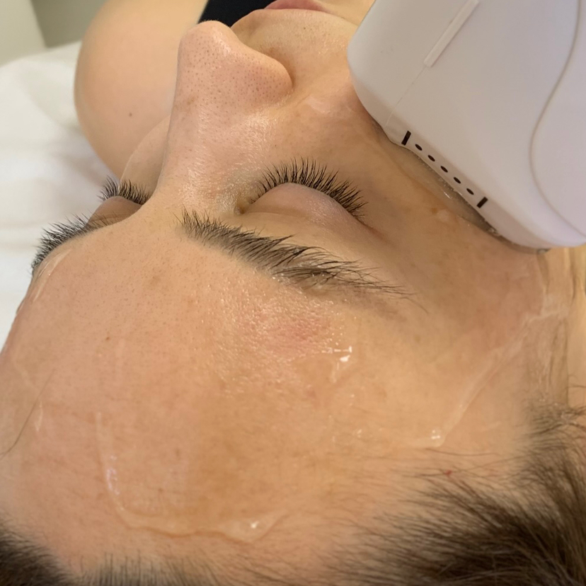 Smas лифтинг (Периорбитальная зона)