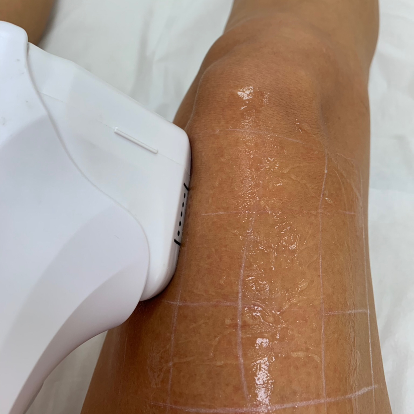 Smas лифтинг (Колени)