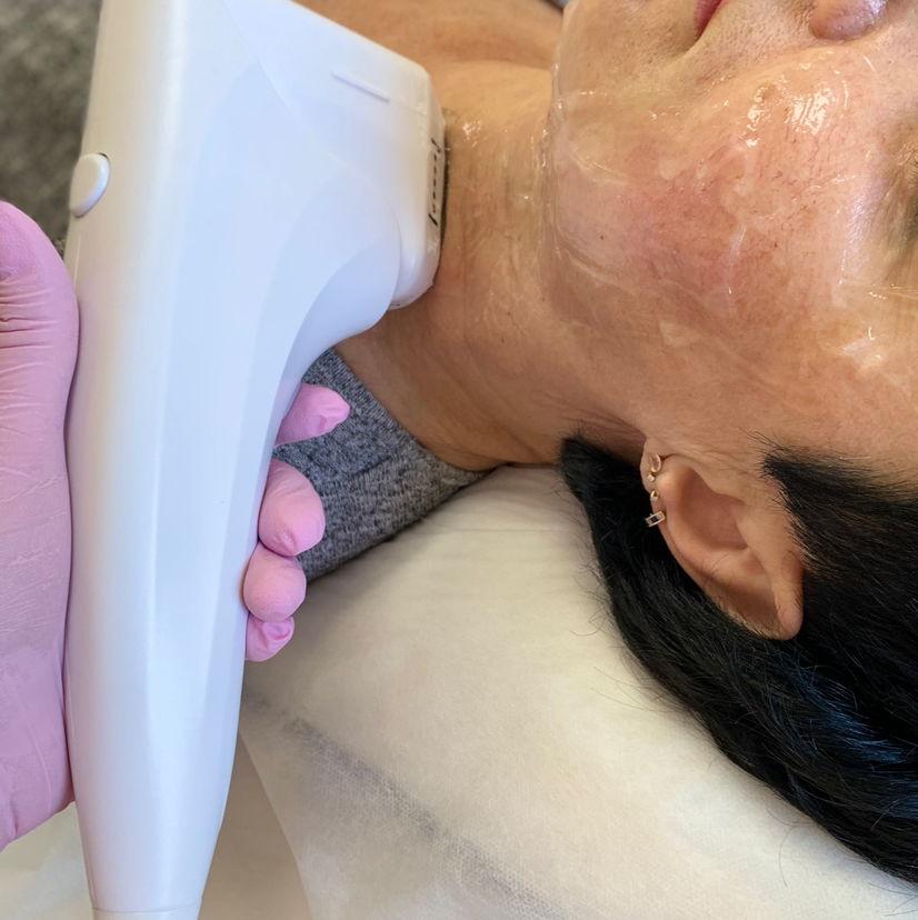 Smas лифтинг (Шея)