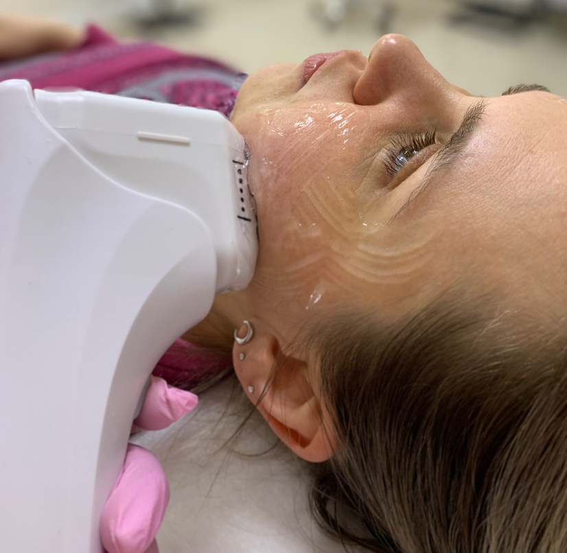 Smas лифтинг (ЛИЦО ПОЛНОСТЬЮ)