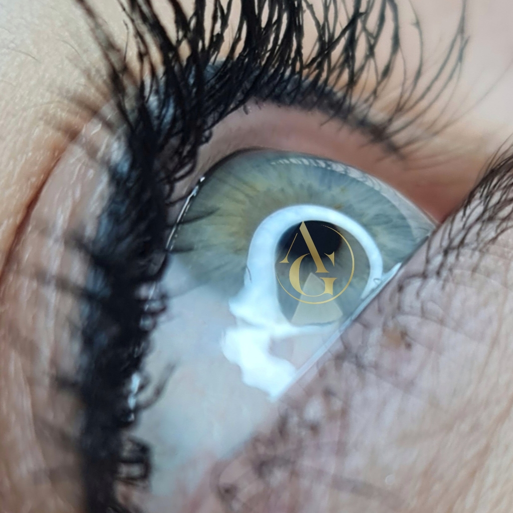 Межресничка