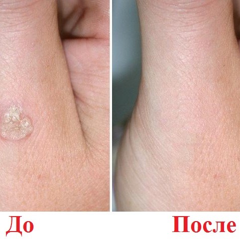 Удаление бородавки, стоимость за 1шт.