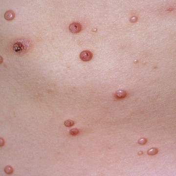 Удаление контагиозного моллюска, стоимость за 1шт., от 6 шт.