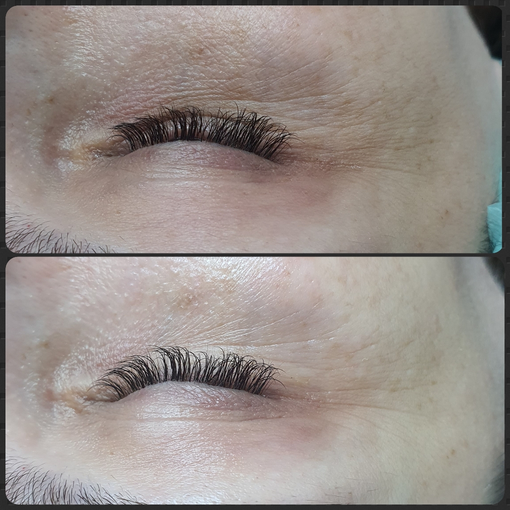 Реконструкция кожи 