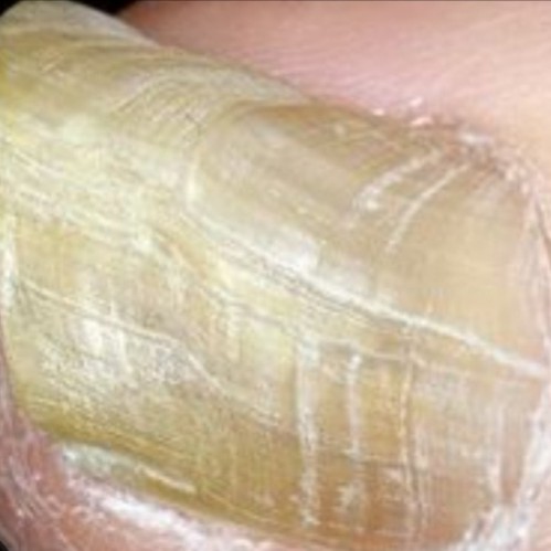 Зачистка онихогрифозных ногтей.