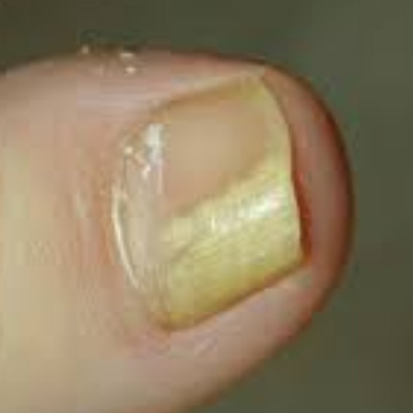 Зачистка онихолизиса