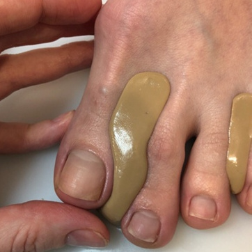 Изготовление бандажей и ортезов