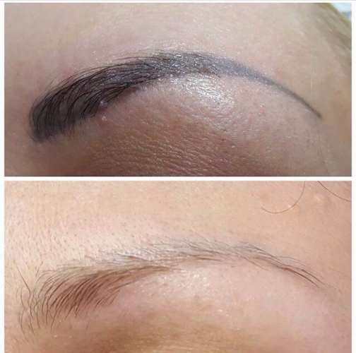 Удаление лазером