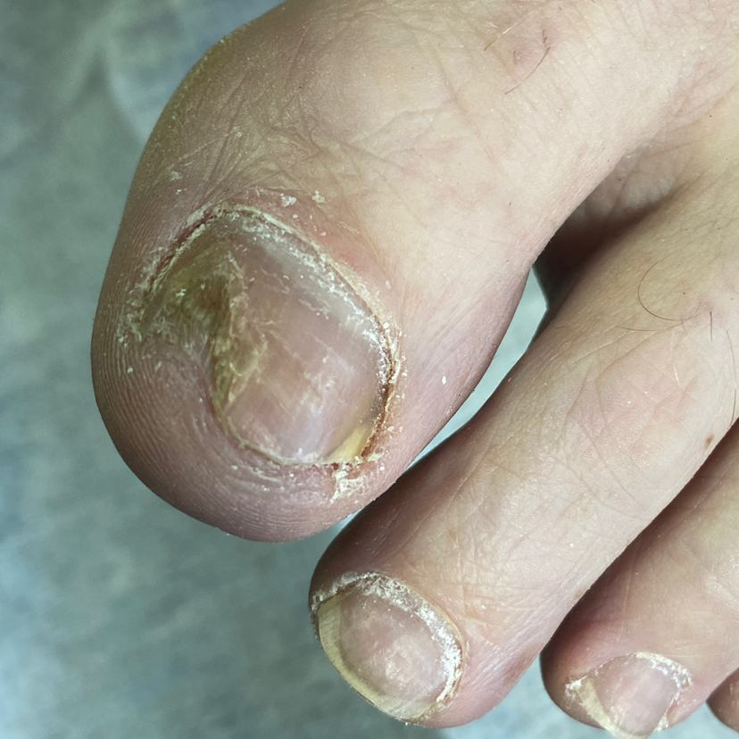 Обработка пальчиков подологическая