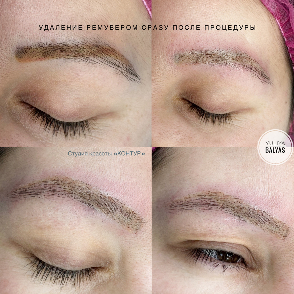 УДАЛЕНИЕ ТАТУАЖА Remover