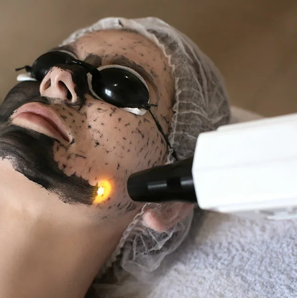 Карбоновый пилинг+чистка лица