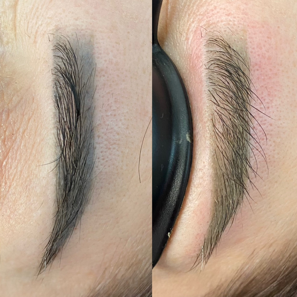 Удаление татуажа