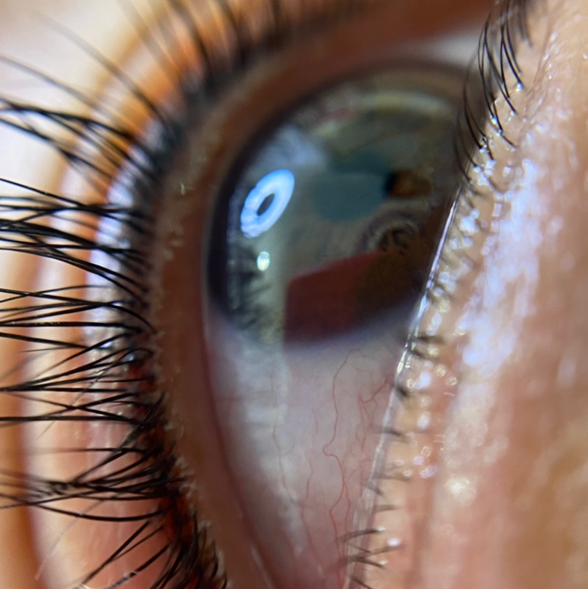 Межресничка