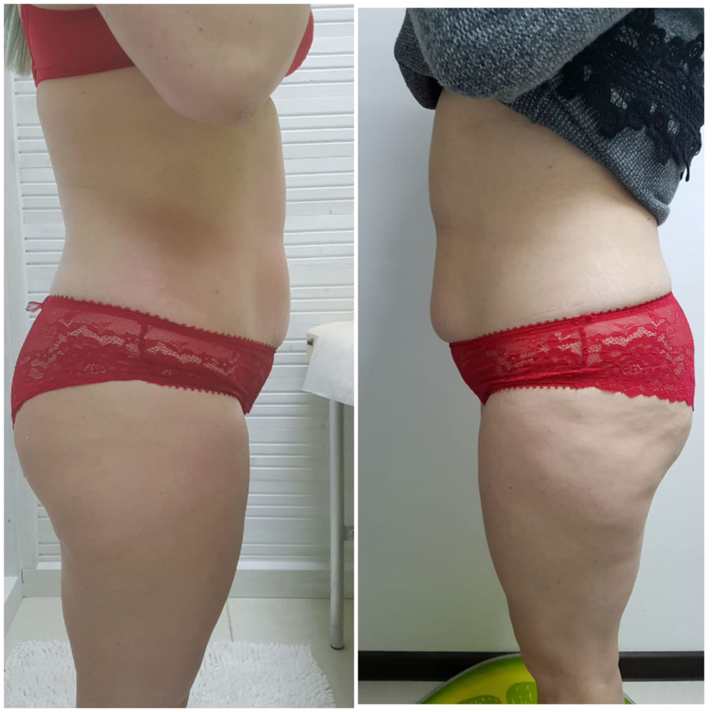 Комплекс 1. Кавитация бёдер и живота. Сеанс ~10%