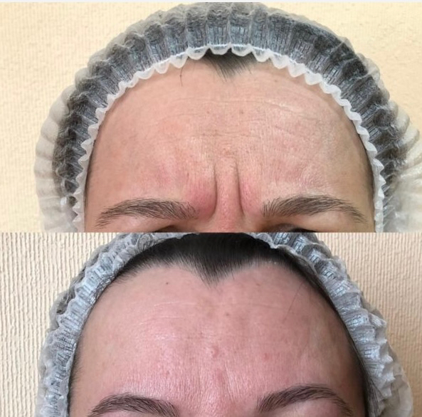 Ботокс межбровье