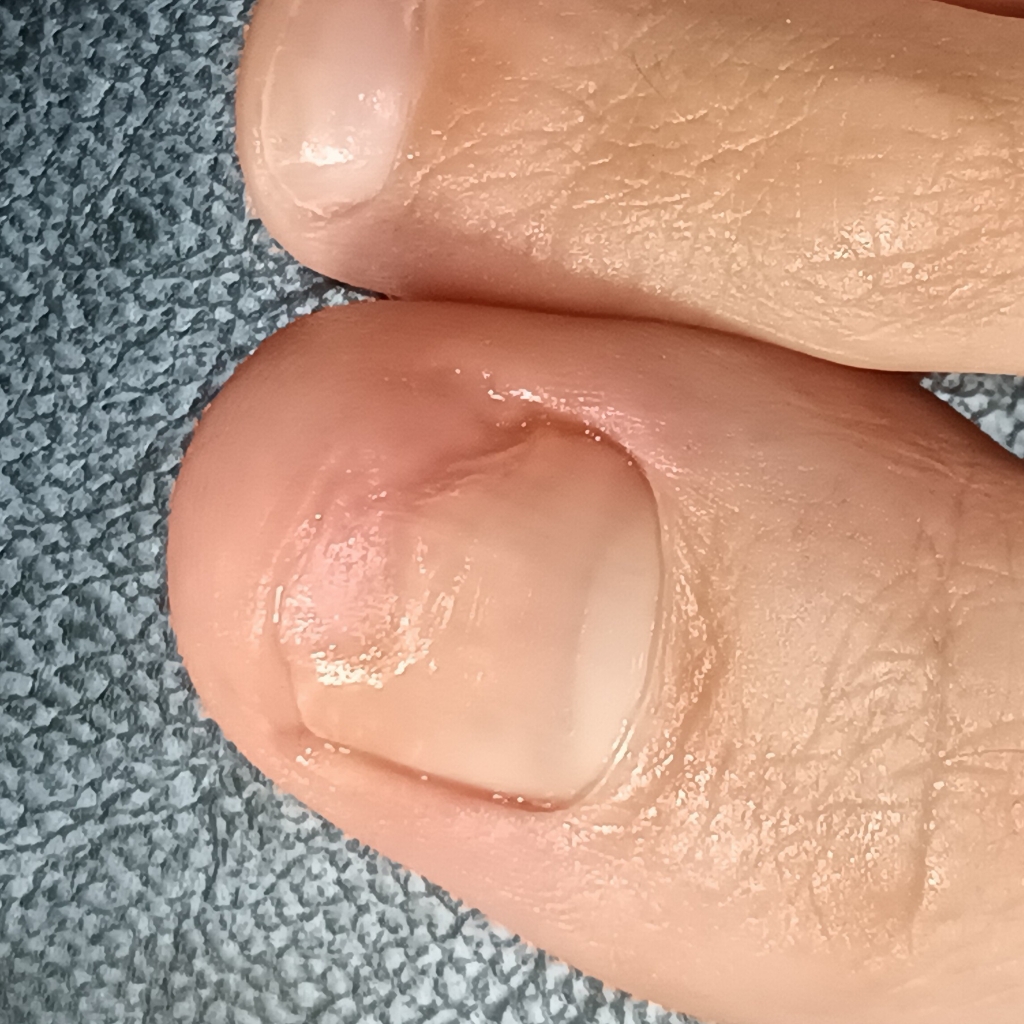 Зачистка онихолизиса