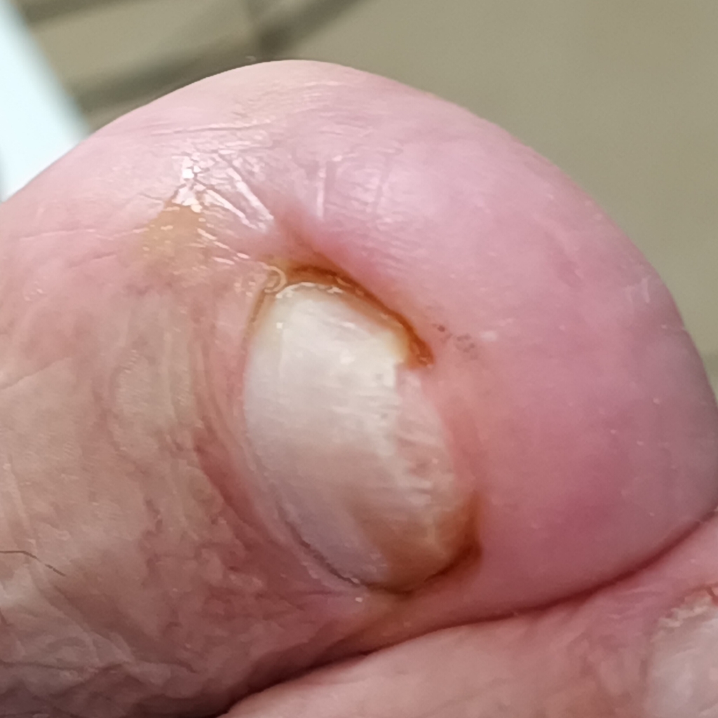 Обработка вросшего  ногтя