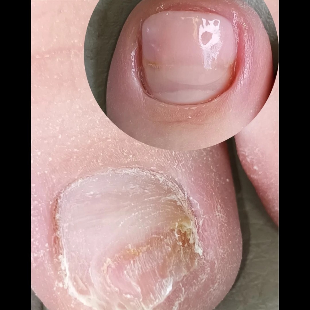 Протезирование ногтевой пластины 15