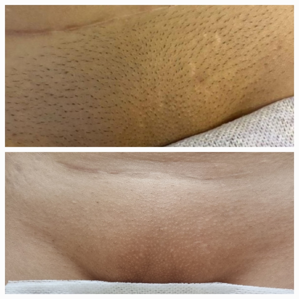 глубокое бикини