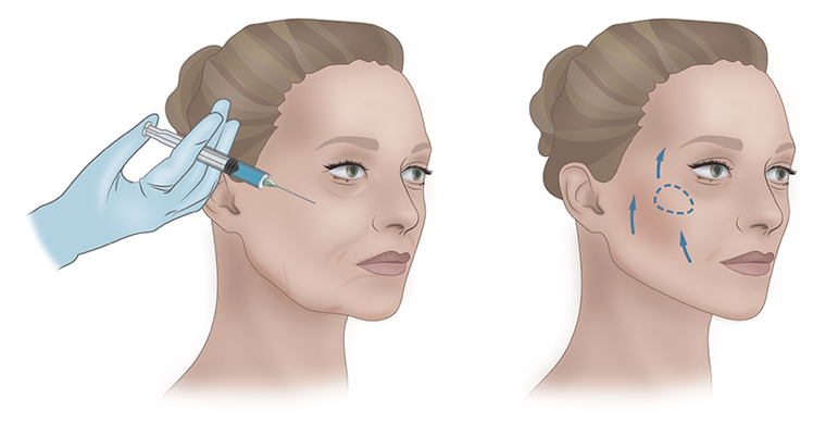 Контурная пластика скул