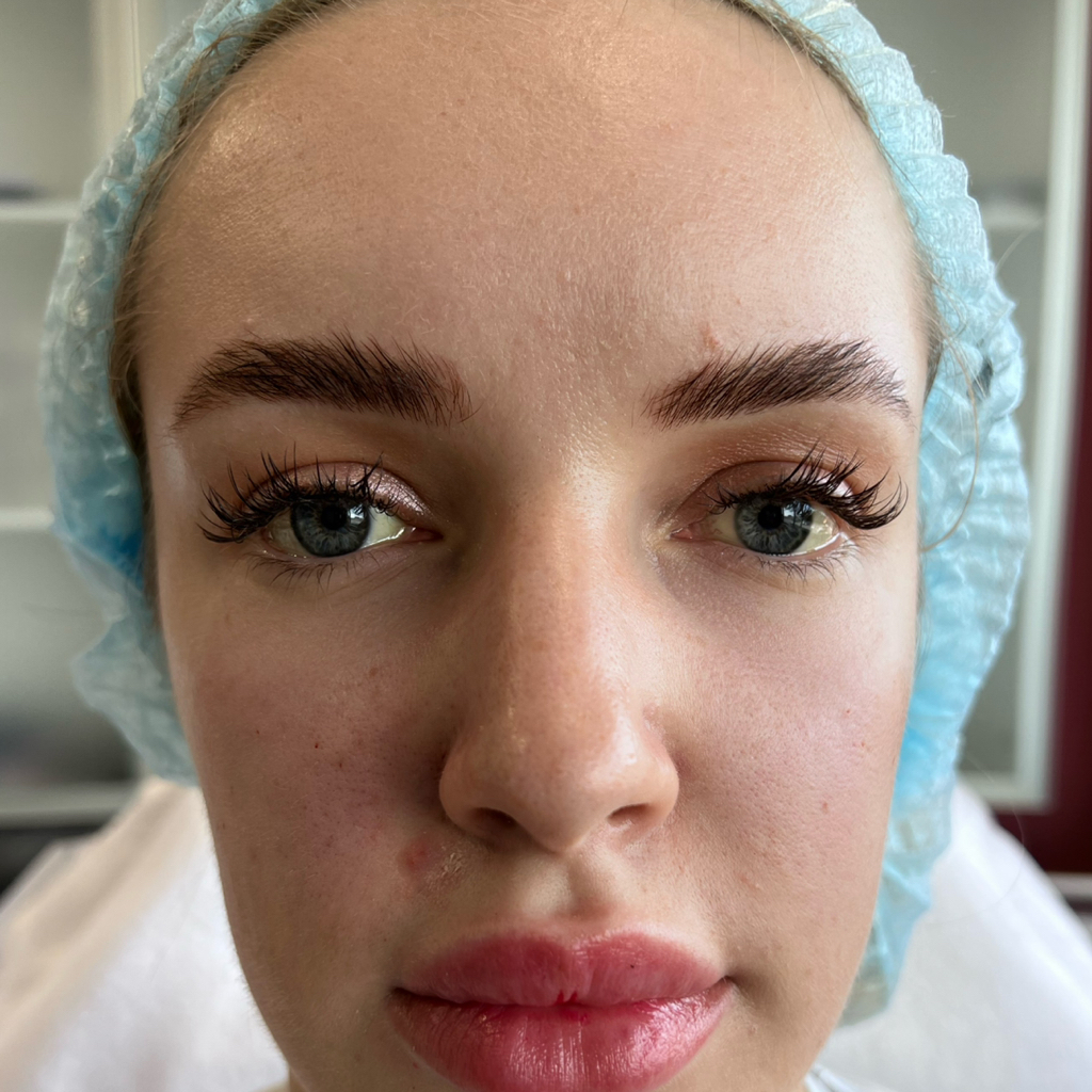 Коррекция носослезной борозды