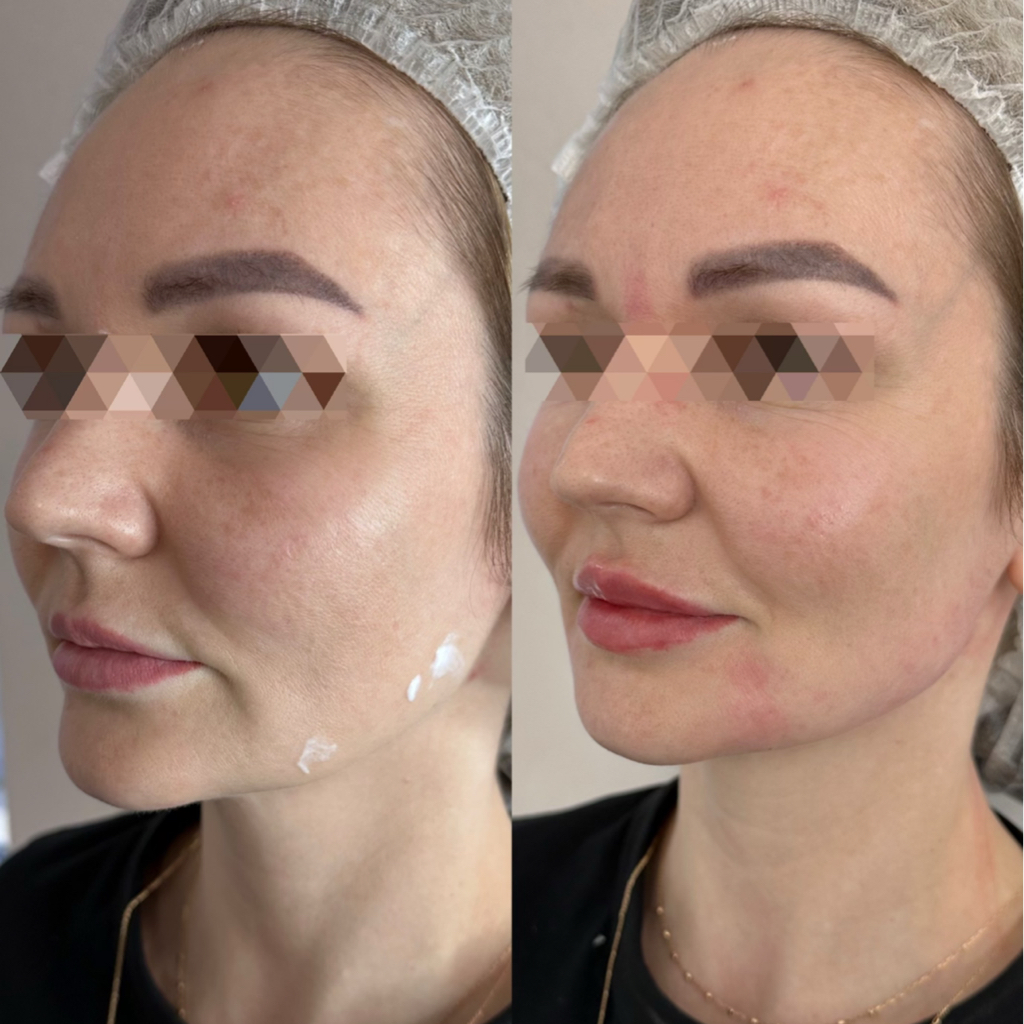 Radiesse контурная пластика