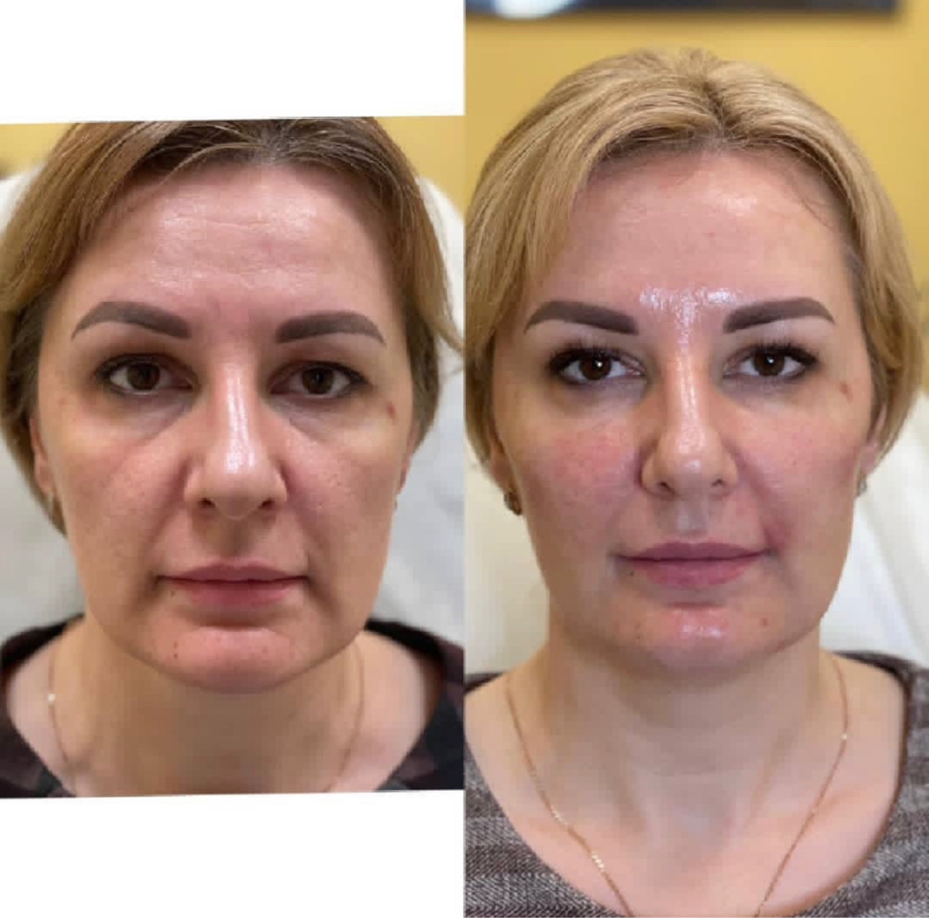 Full face (все лицо + шея) 100ед