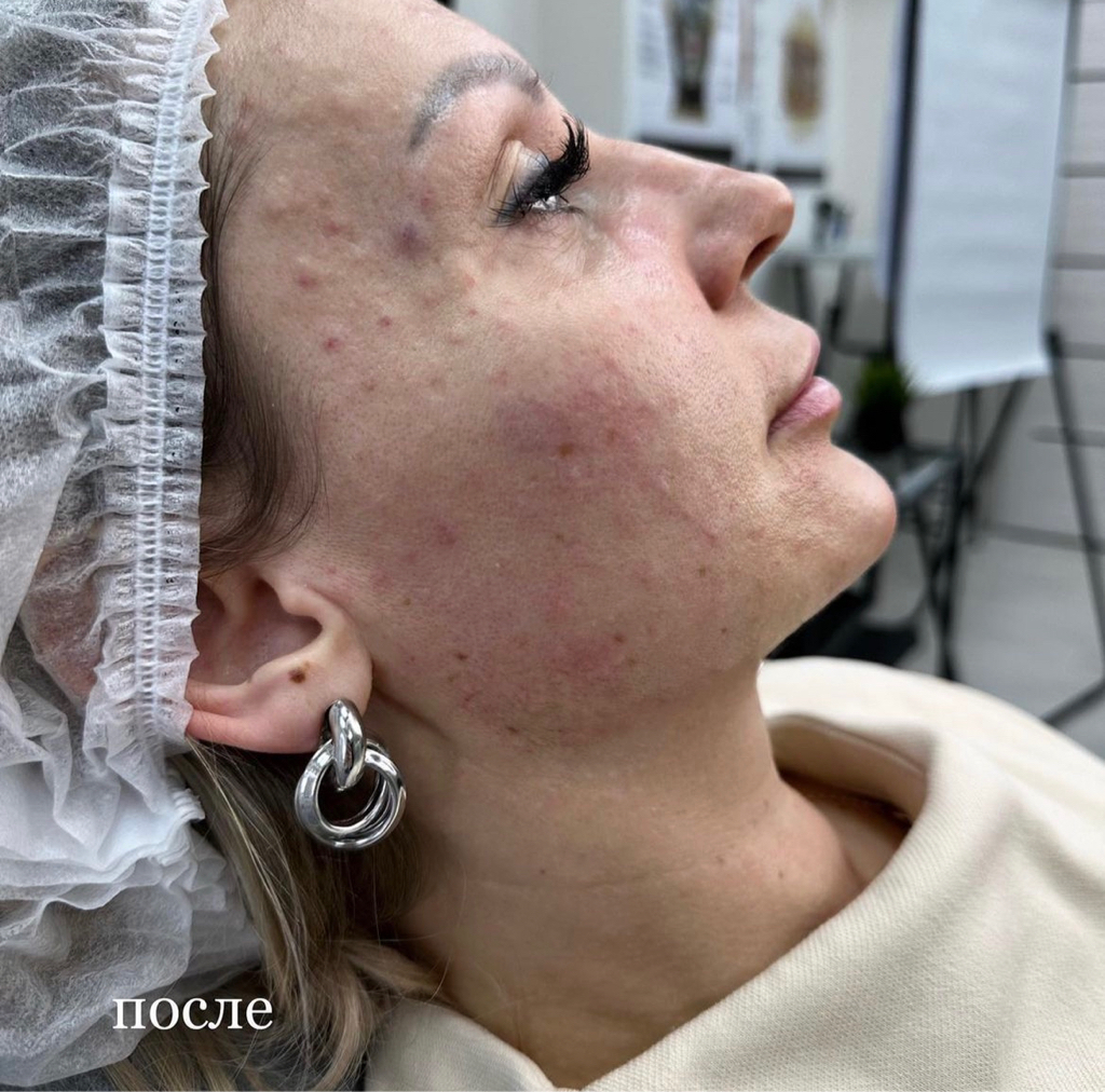 Биоревитализация  Новокутан 2,0 мл