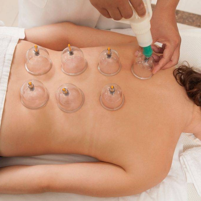 Каппинг-терапия или метод «Ба Хо Гуан»