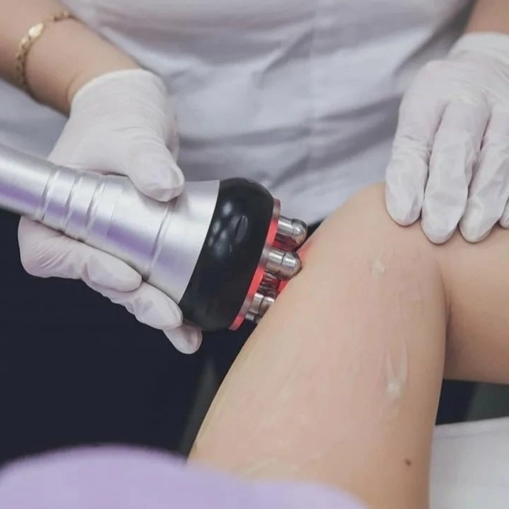 RF- лифтинг тела