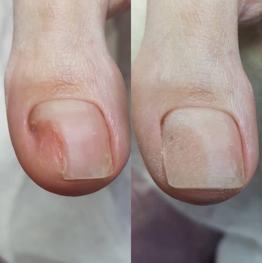 Протезирование ногтевой пластины за ед. во время процедуры