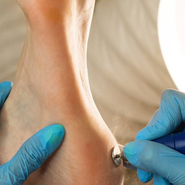 обработка стопы без пальчиков