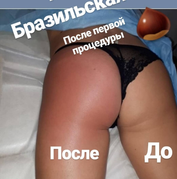 Бразильская Попа (Абонемент 5 процедур)