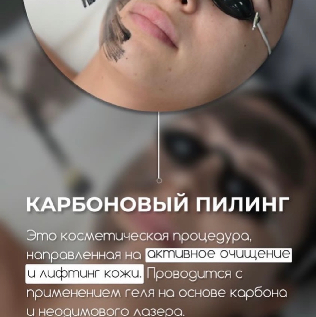 Карбоновый Пилинг (Абонемент 6 процедур)