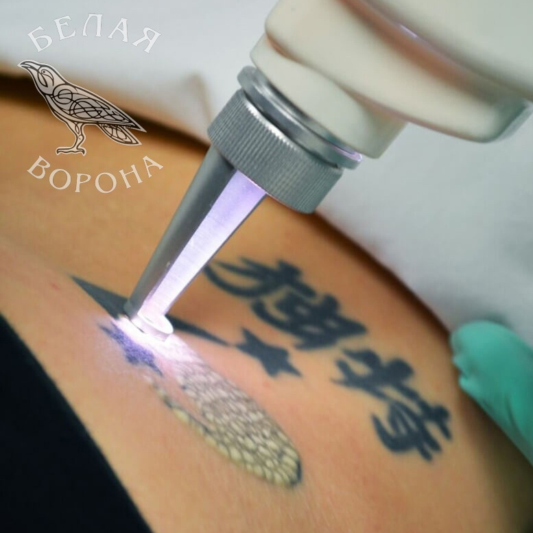 Осветление татуировки при помощи неодимового лазера