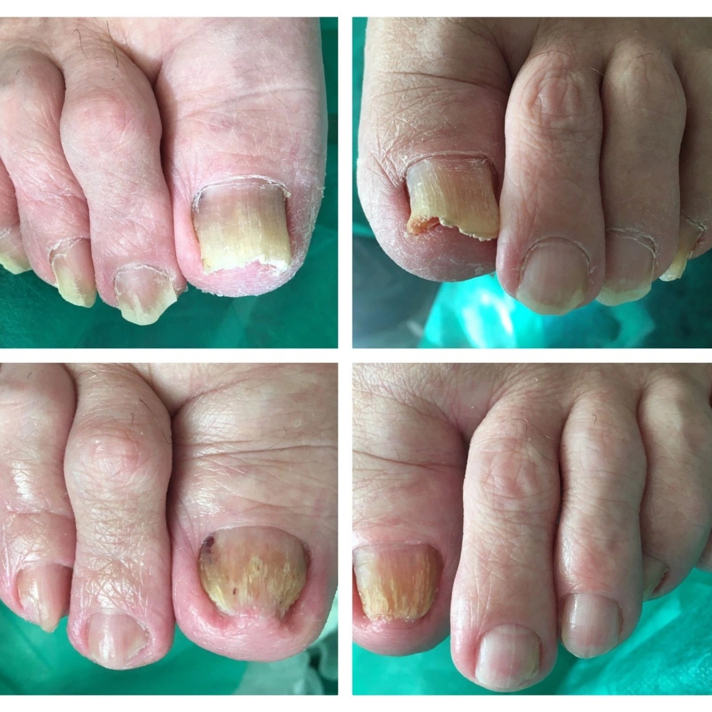 Педикюр 1 категория (1-10 повреждённых ногтей)