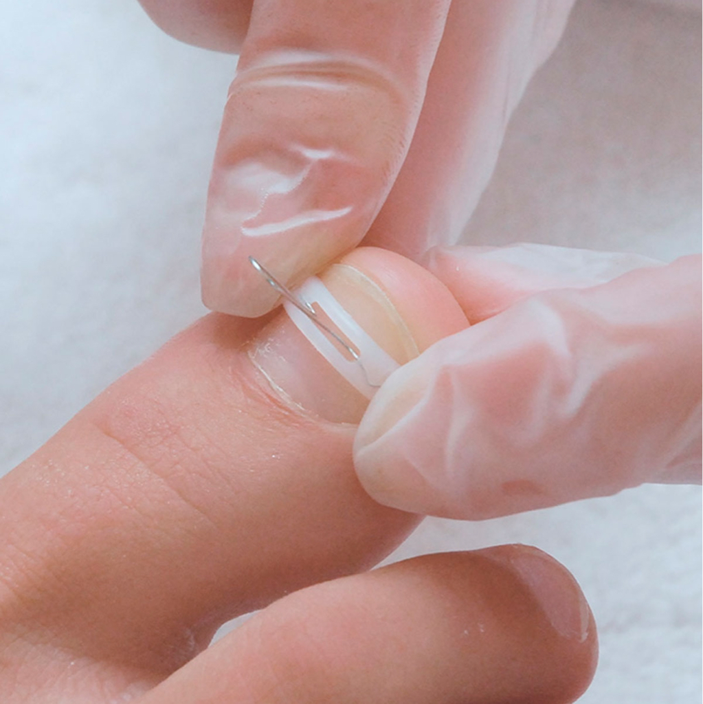 Тампонирование ногтевой пластины (1 ед.)