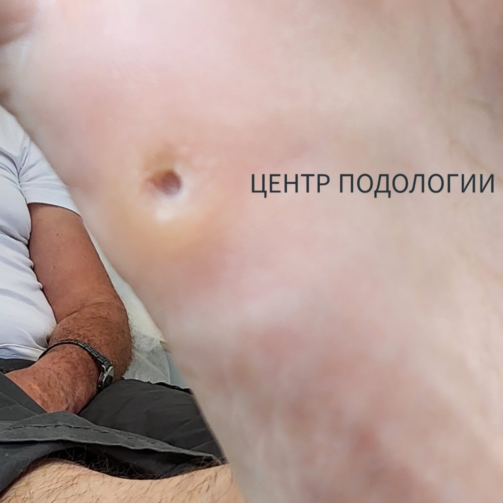 Обработка стержневой мозоли