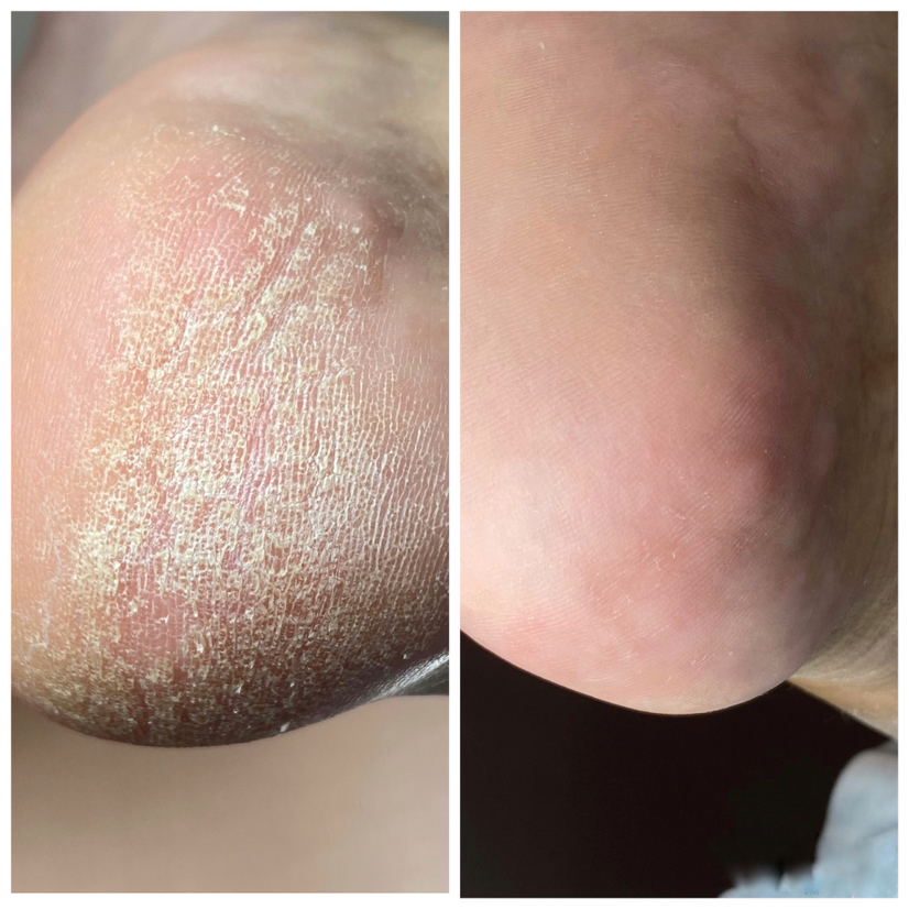 Гигиенический педикюр