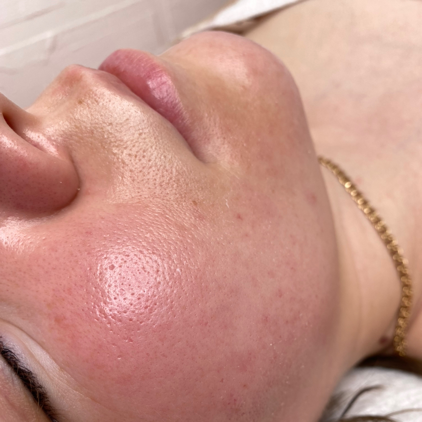 Химическая чистка лица (на ТСА)