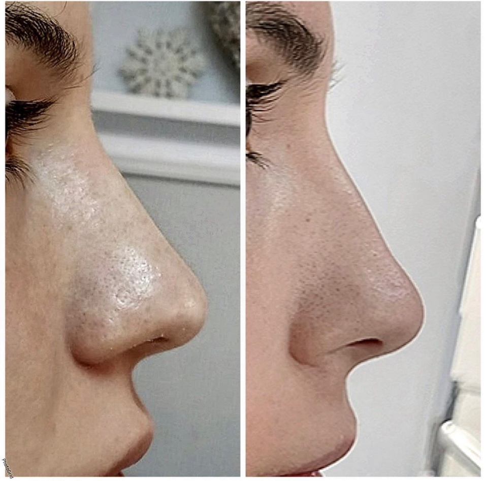 BOTOX NOSE
