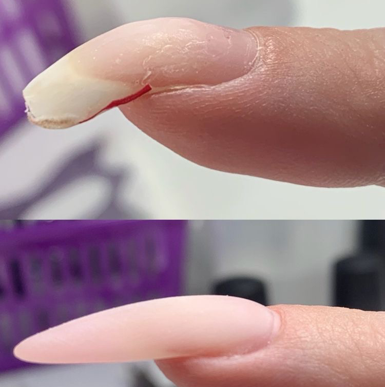 Поднятие клюющего ногтя