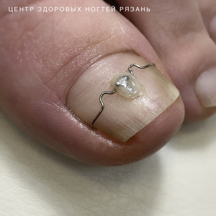 Скоба 3-ТО