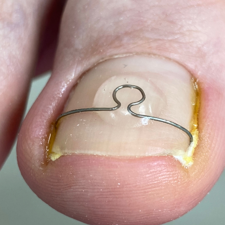 Установка скобы(фрезера,ora,3TO)