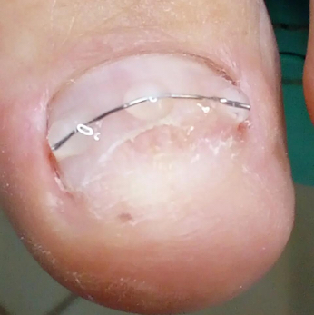 Установка BS пластины, титановая нить( 1 палец)