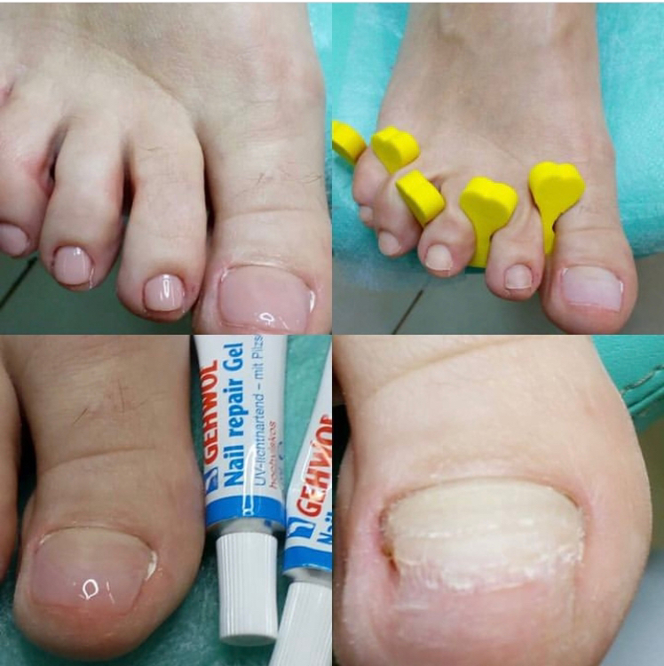 Первичное Протезирование ногтя большой палец 1500, маленький 800) с зачисткой