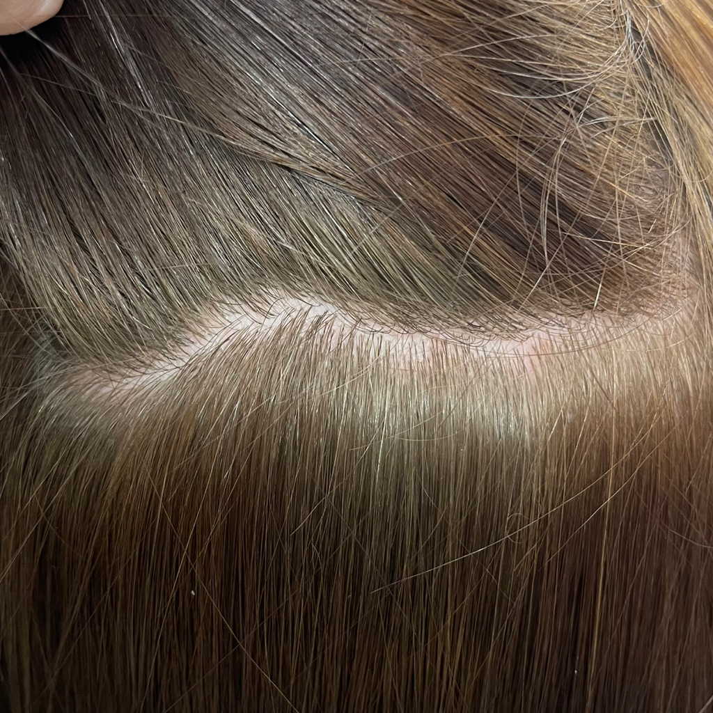 Пилинг кожи головы