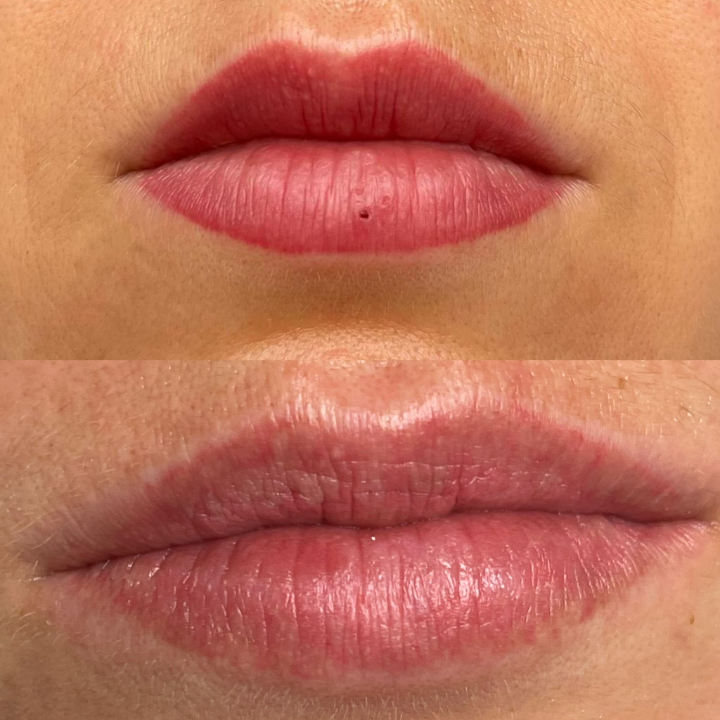 Tatto removal / удоление татуажа