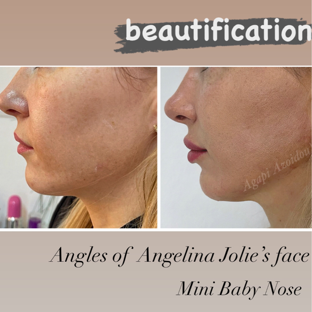 BEAUTIFICATION - BABY FACE&BODY (Διόρθωση μικρό ατέλειες)2 θεραπειες Ανόρθωση λίφτινγκ